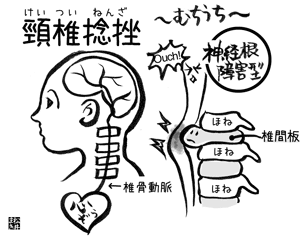 むちうち