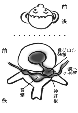 頚椎椎間板ヘルニア