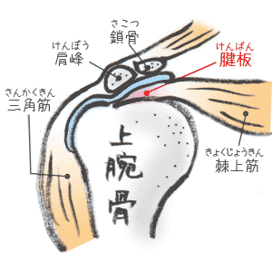 石灰沈着型腱板炎